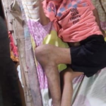Vida Sana Para Todos 15 Sindrome de Proteus